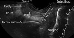 Vagina sonogram